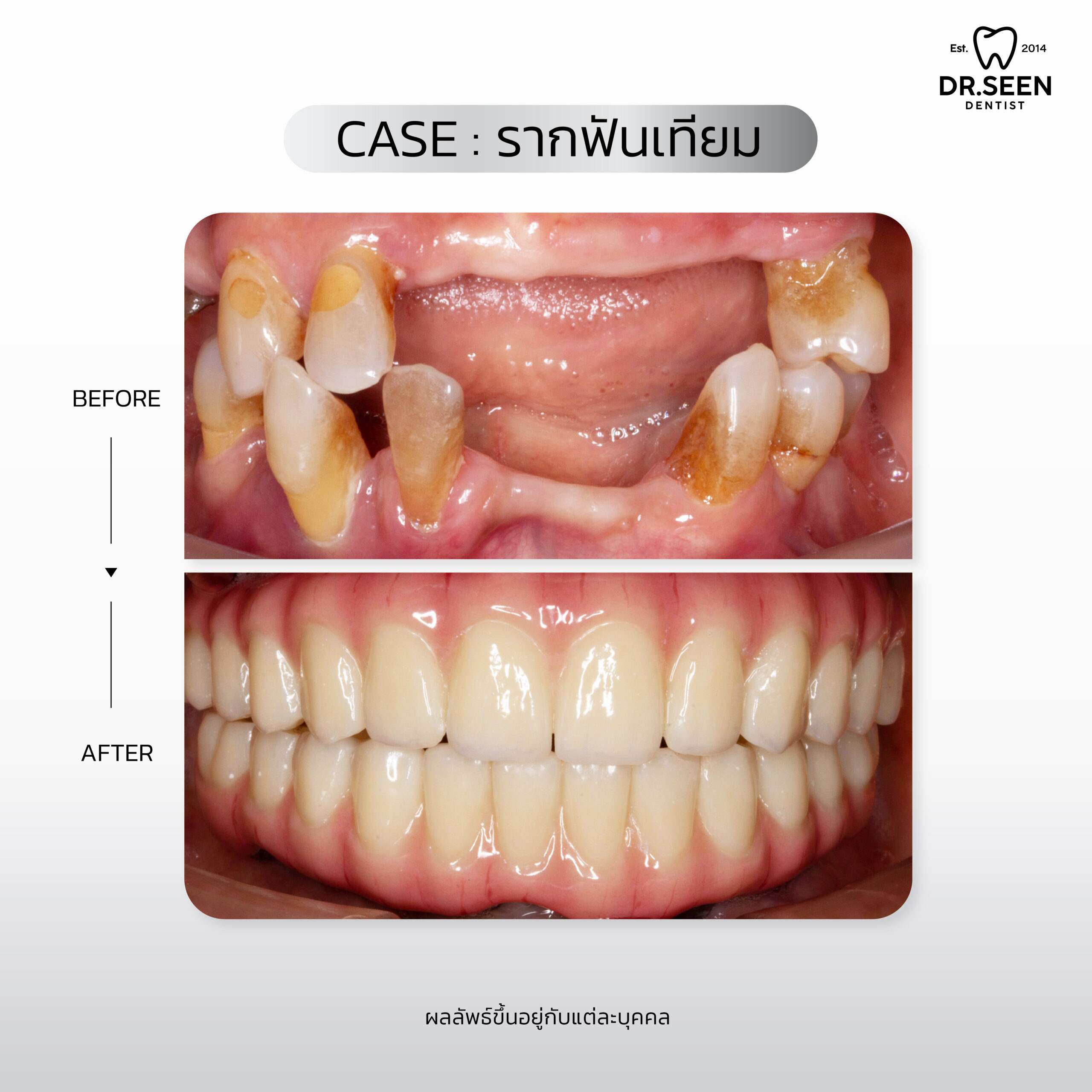 รีวิวรากฟัน-01