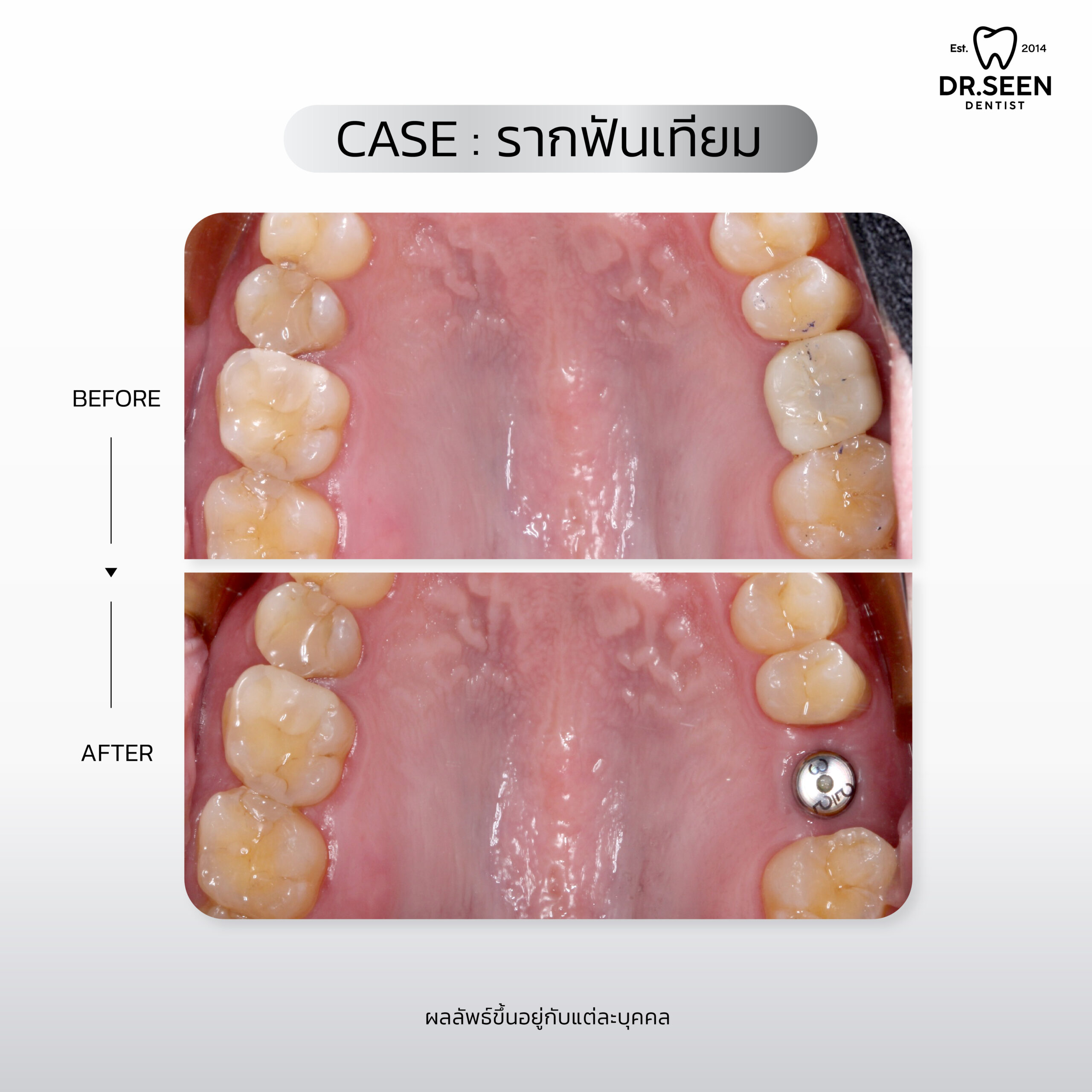 รีวิวรากฟัน-02