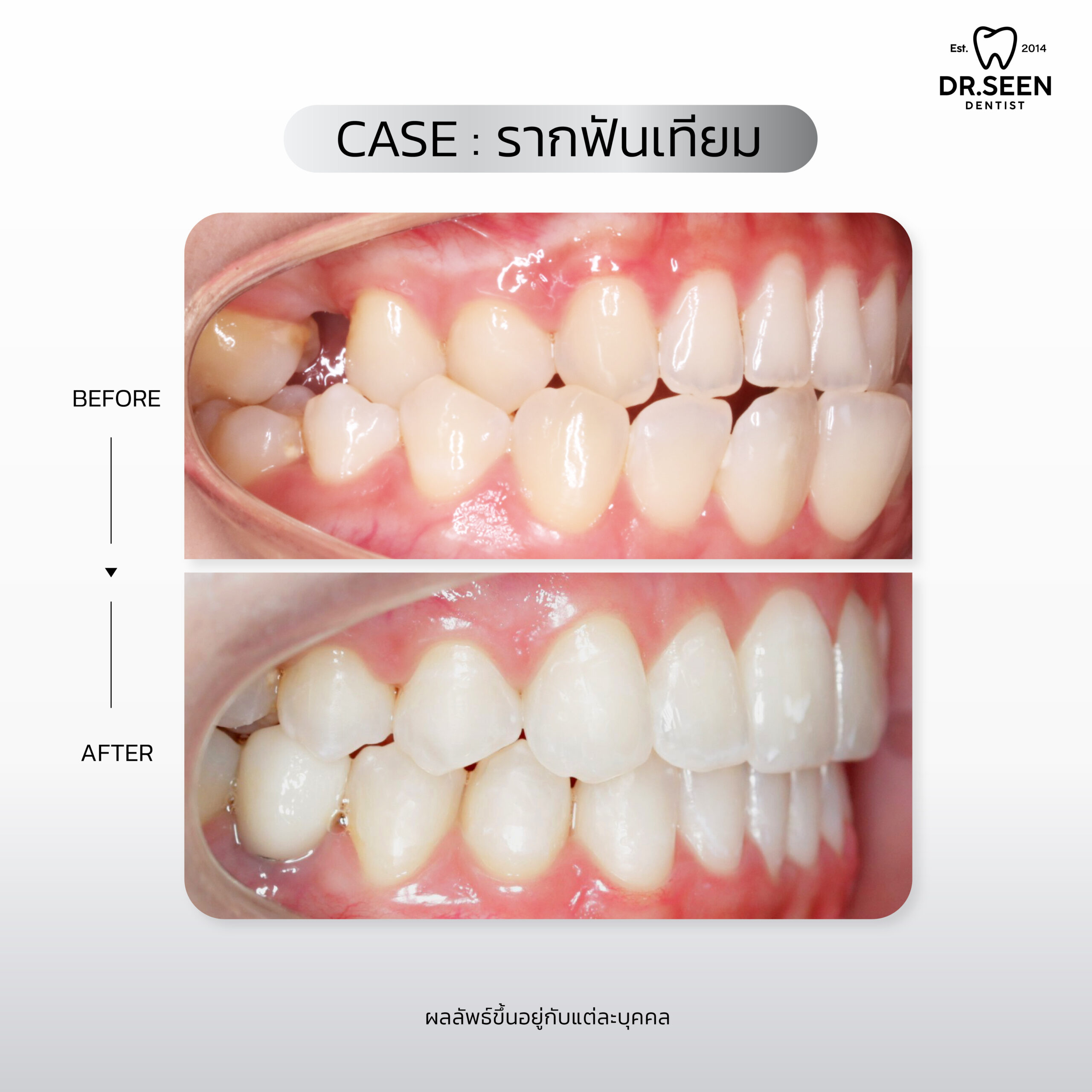 รีวิวรากฟัน-03