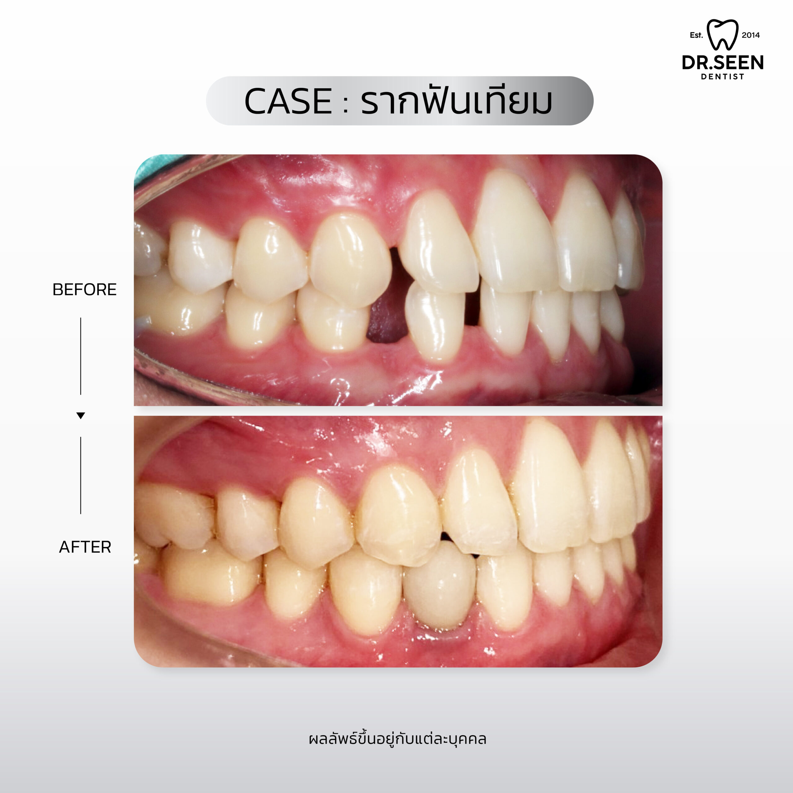 รีวิวรากฟัน-04